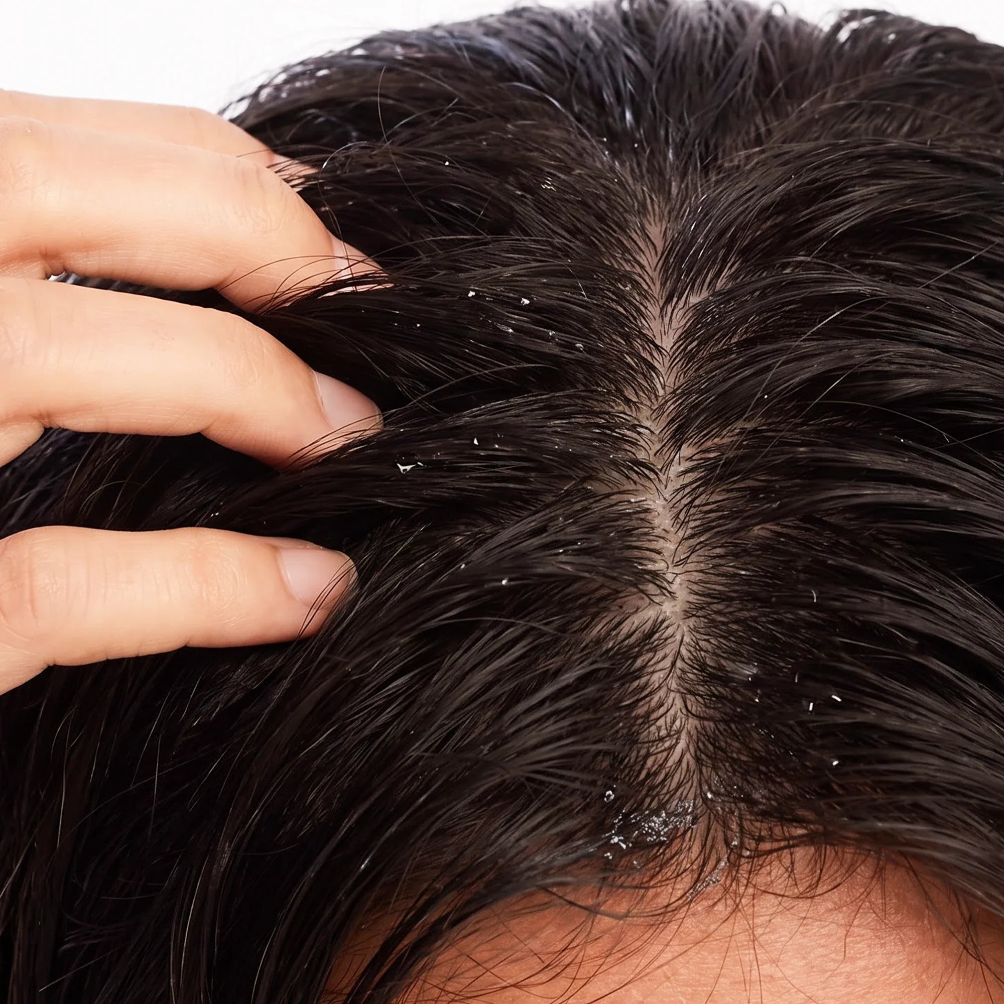 Dandruff