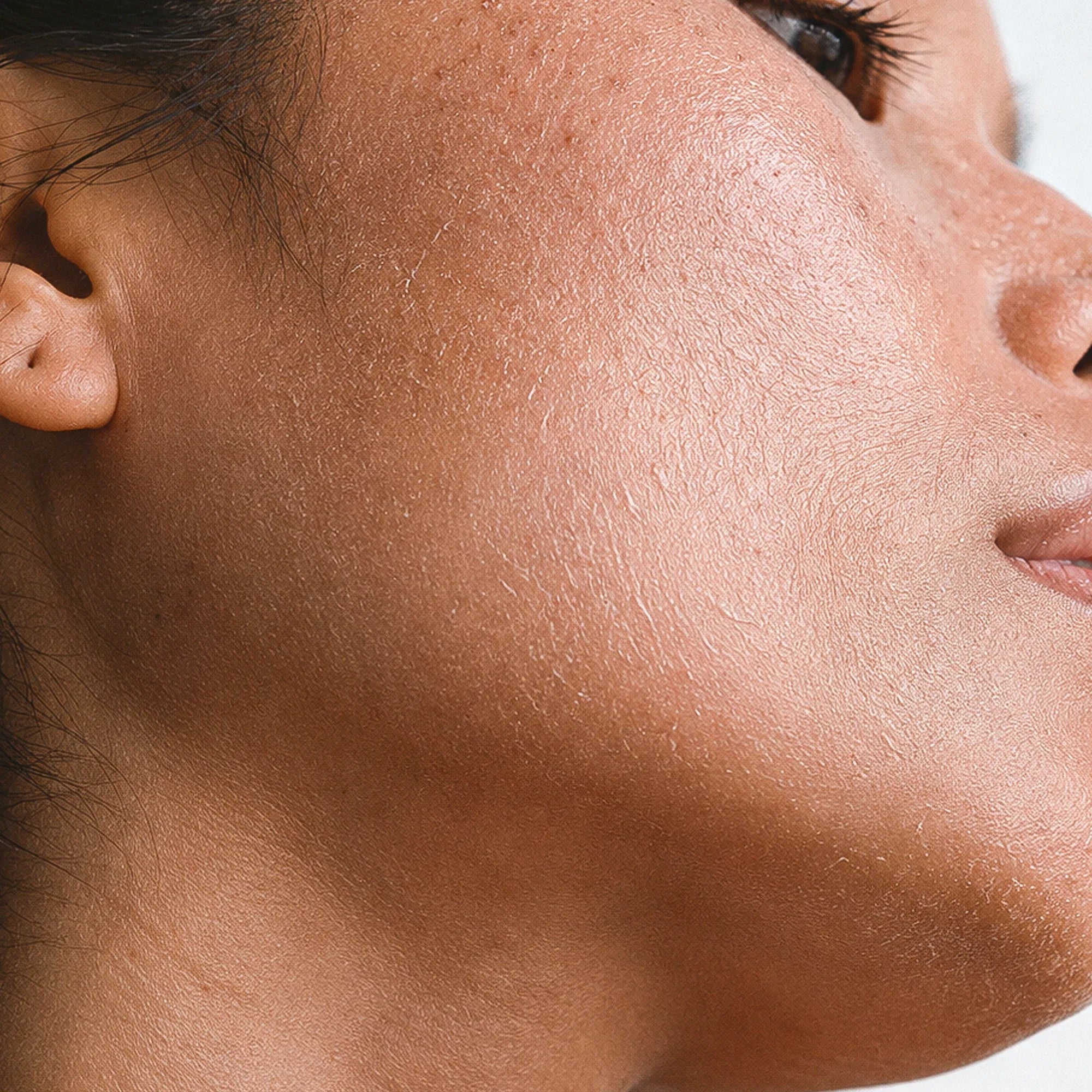 Dry Skin